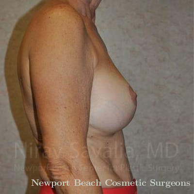 Mastectomy Reconstruction Revision Before & After Gallery - Patient 1655552 - After