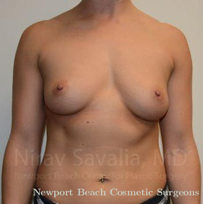 Breast Explantation En Bloc Capsulectomy Before & After Gallery - Patient 1655553 - Before