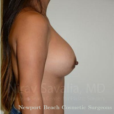 Breast Lift without Implants Before & After Gallery - Patient 1655554 - After