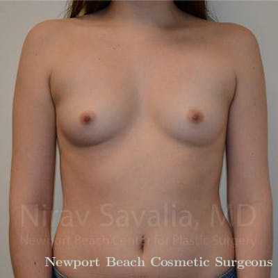 Oncoplastic Reconstruction Before & After Gallery - Patient 1655555 - Before
