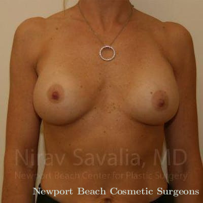 Breast Implant Revision Before & After Gallery - Patient 1655556 - Before