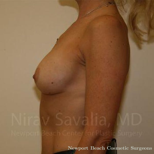 Breast Explantation En Bloc Capsulectomy Before & After Gallery - Patient 1655556 - Before