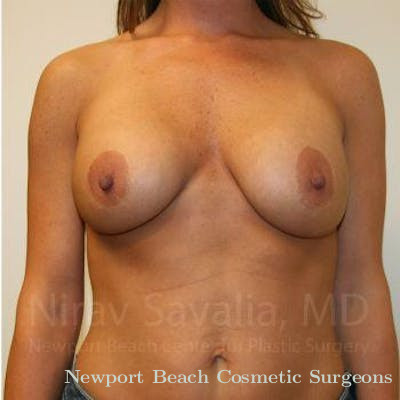 Breast Implant Revision Before & After Gallery - Patient 1655558 - Before