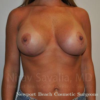 Chin Implants Before & After Gallery - Patient 1655558 - After