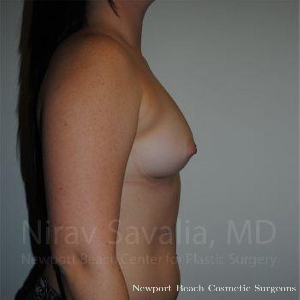 Breast Augmentation Before & After Gallery - Patient 1655559 - Before