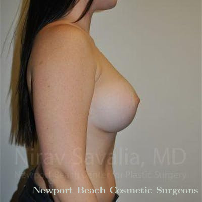 Fat Grafting to Face Before & After Gallery - Patient 1655559 - After