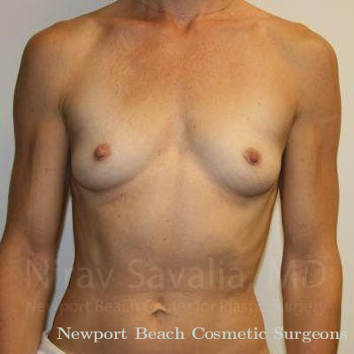 Chin Implants Before & After Gallery - Patient 1655561 - Before