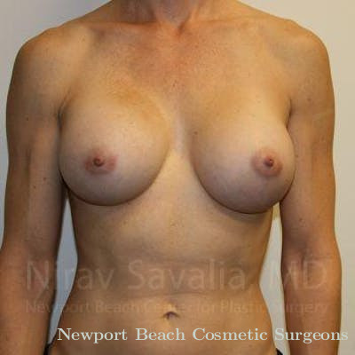 Breast Lift without Implants Before & After Gallery - Patient 1655561 - After