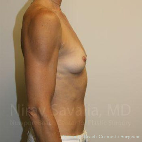 Mastectomy Reconstruction Revision Before & After Gallery - Patient 1655561 - Before