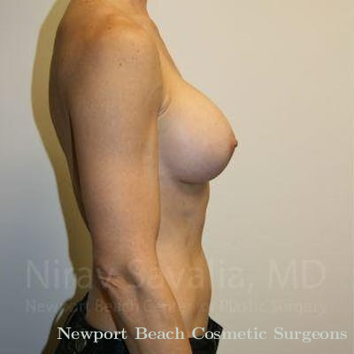 Fat Grafting to Face Before & After Gallery - Patient 1655561 - After