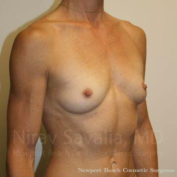 Breast Explantation En Bloc Capsulectomy Before & After Gallery - Patient 1655561 - Before