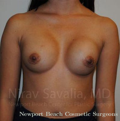 Breast Implant Revision Before & After Gallery - Patient 1655564 - Before