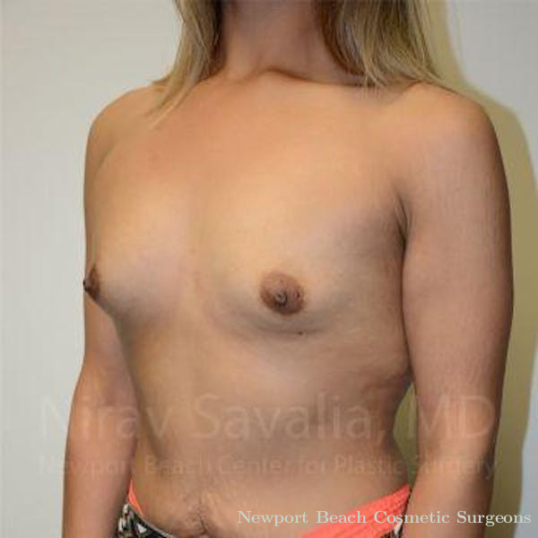 Mastectomy Reconstruction Revision Before & After Gallery - Patient 1655563 - Before