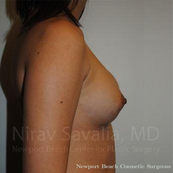 Oncoplastic Reconstruction Before & After Gallery - Patient 1655564 - Before