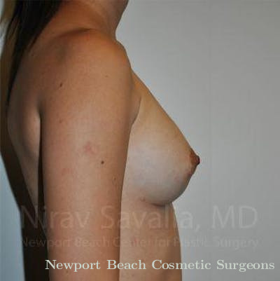 Breast Reduction Before & After Gallery - Patient 1655564 - After