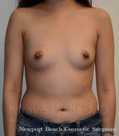 Breast Implant Revision Before & After Gallery - Patient 1655566 - Before