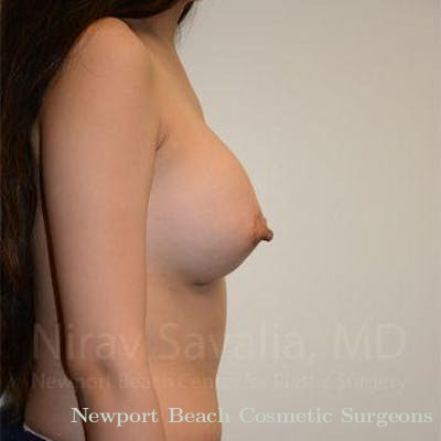 Breast Augmentation Before & After Gallery - Patient 1655566 - After
