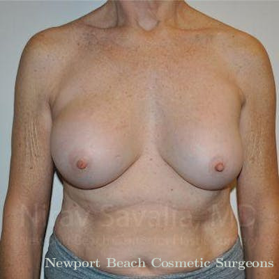 Mastectomy Reconstruction Revision Before & After Gallery - Patient 1655567 - Before