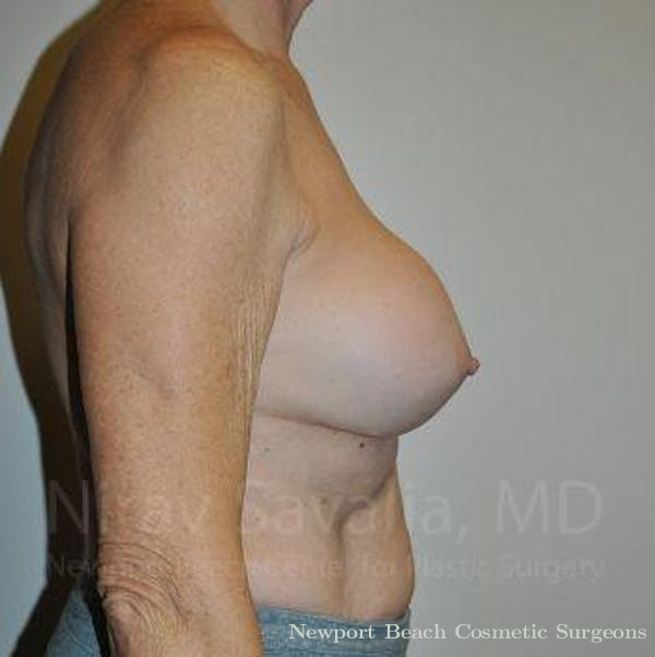 Facelift Before & After Gallery - Patient 1655567 - Before