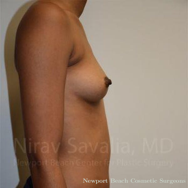 Mastectomy Reconstruction Revision Before & After Gallery - Patient 1655568 - Before