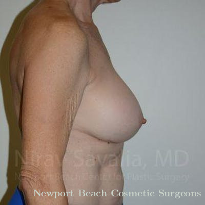Breast Augmentation Before & After Gallery - Patient 1655567 - After