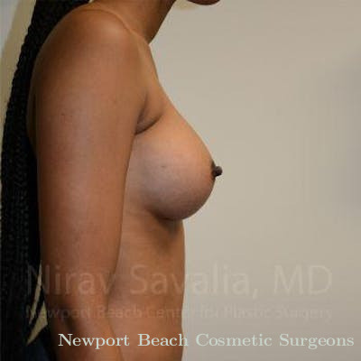Chin Implants Before & After Gallery - Patient 1655568 - After
