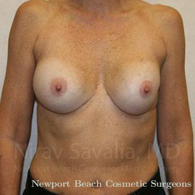 Breast Lift with Implants Before & After Gallery - Patient 1655570 - Before