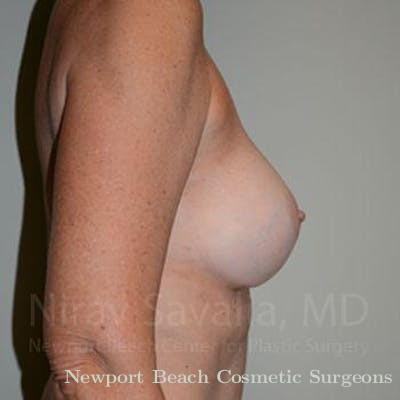 Breast Explantation En Bloc Capsulectomy Before & After Gallery - Patient 1655570 - After