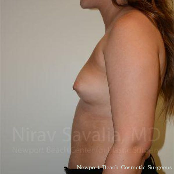 Oncoplastic Reconstruction Before & After Gallery - Patient 1655571 - Before