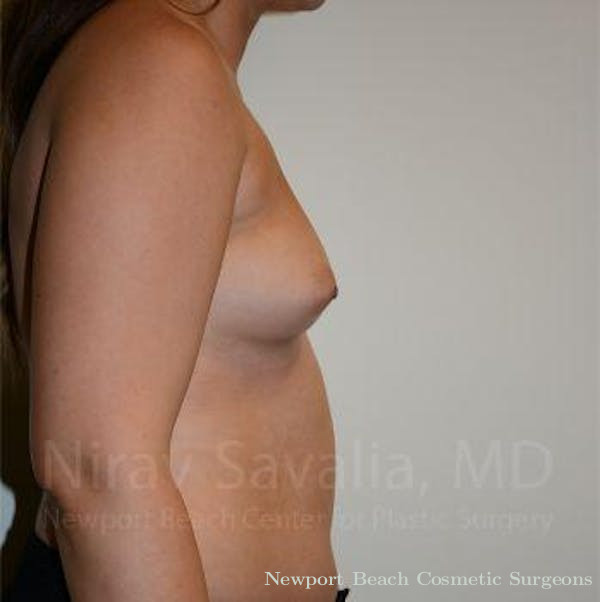 Mastectomy Reconstruction Revision Before & After Gallery - Patient 1655571 - Before