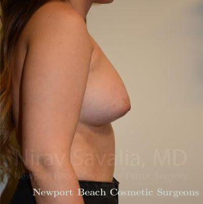 Body Contouring after Weight Loss Before & After Gallery - Patient 1655571 - After