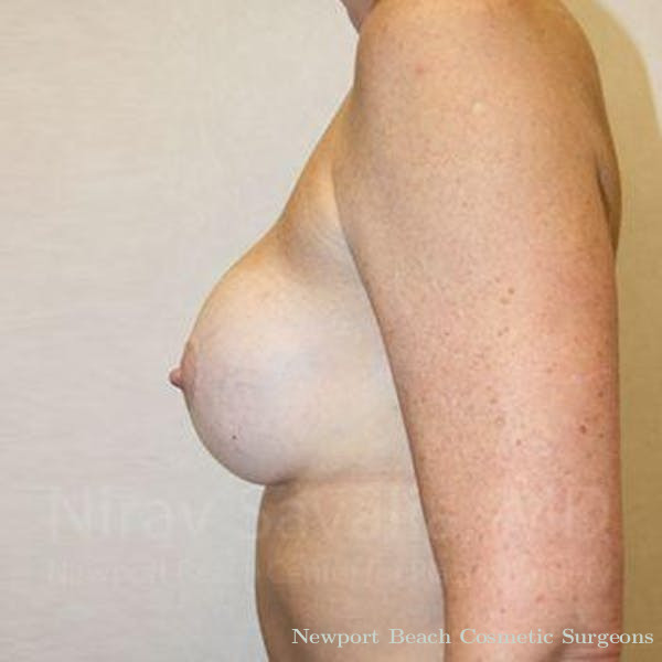Facelift Before & After Gallery - Patient 1655570 - Before