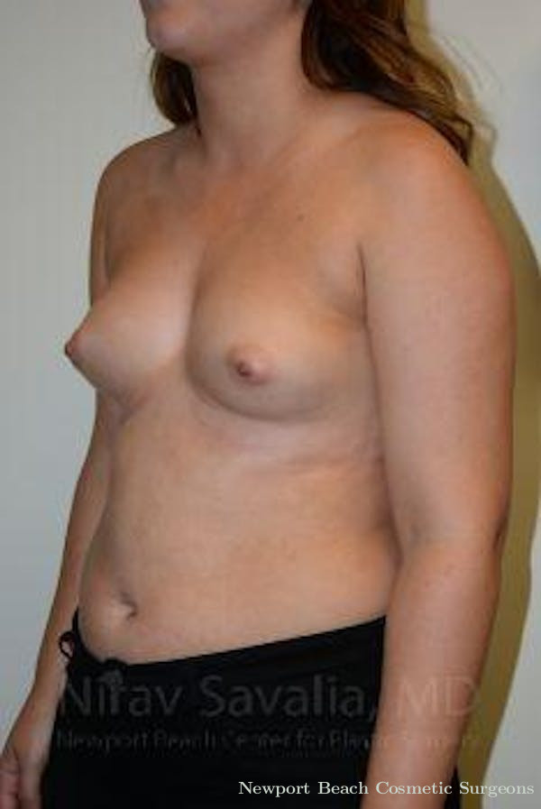Mastectomy Reconstruction Revision Before & After Gallery - Patient 1655571 - Before