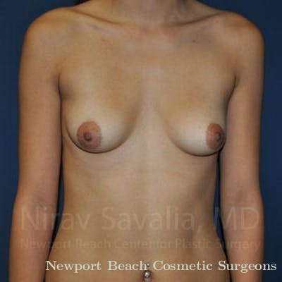 Mastectomy Reconstruction Revision Before & After Gallery - Patient 1655573 - Before