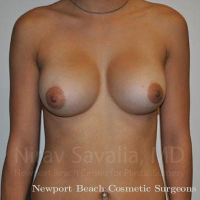 Breast Implant Revision Before & After Gallery - Patient 1655573 - After