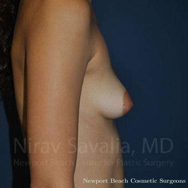 Oncoplastic Reconstruction Before & After Gallery - Patient 1655573 - Before