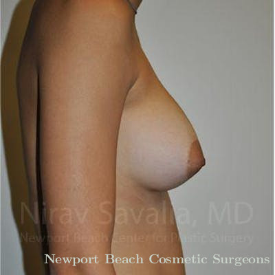 Oncoplastic Reconstruction Before & After Gallery - Patient 1655573 - After