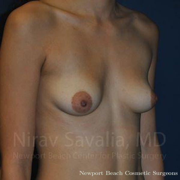 Breast Augmentation Before & After Gallery - Patient 1655573 - Before