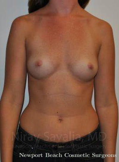 Thigh Lift Before & After Gallery - Patient 1655574 - Before