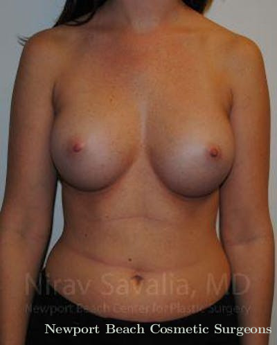 Arm Lift Before & After Gallery - Patient 1655574 - After