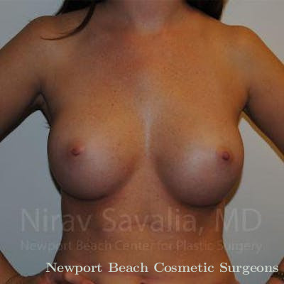 Breast Explantation En Bloc Capsulectomy Before & After Gallery - Patient 1655574 - After