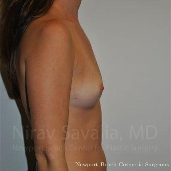 Mastectomy Reconstruction Revision Before & After Gallery - Patient 1655574 - Before