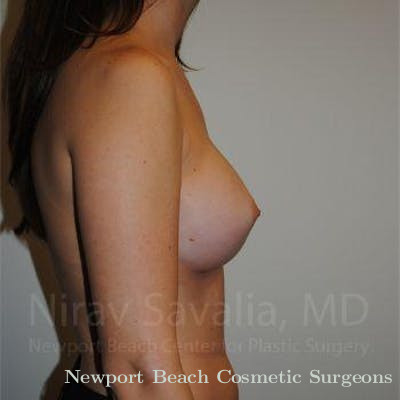 Chin Implants Before & After Gallery - Patient 1655574 - After