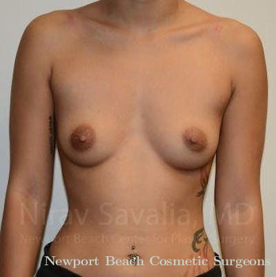 Mastectomy Reconstruction Revision Before & After Gallery - Patient 1655575 - Before