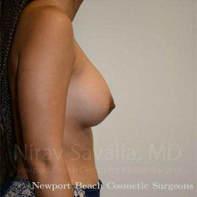 Breast Explantation En Bloc Capsulectomy Before & After Gallery - Patient 1655575 - After