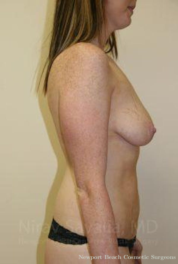 Breast Reduction Before & After Gallery - Patient 1655579 - Before