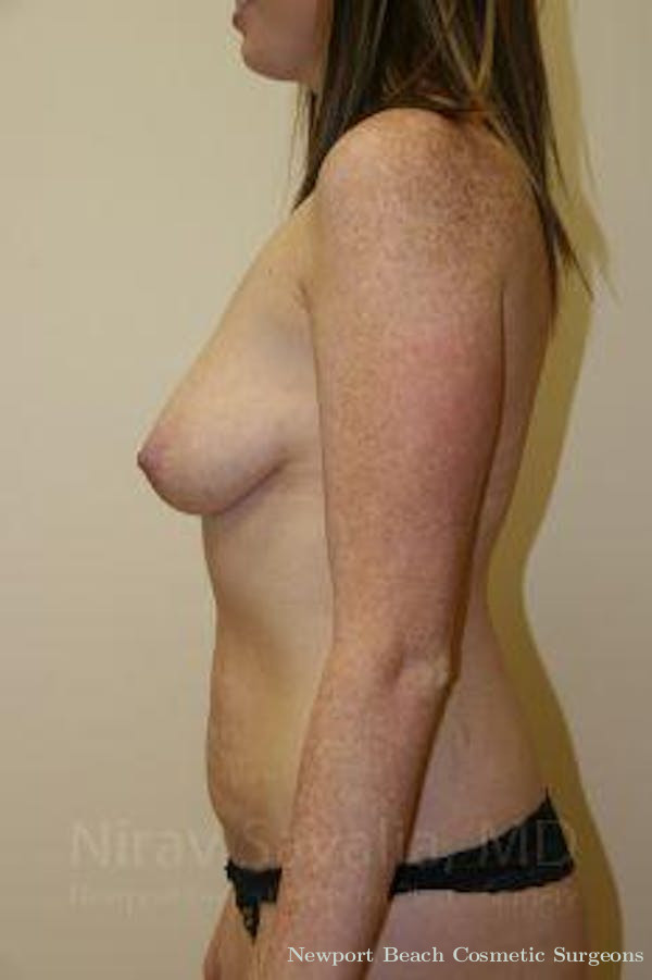 Mastectomy Reconstruction Revision Before & After Gallery - Patient 1655579 - Before