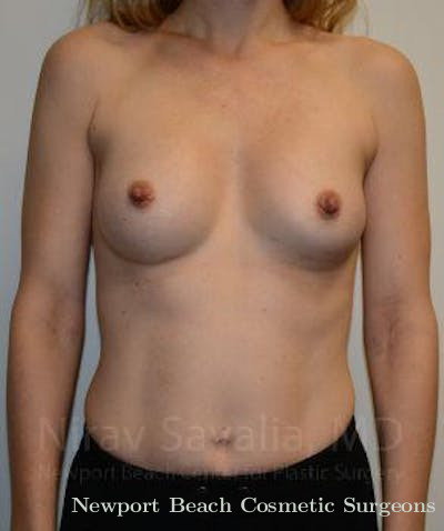 Breast Explantation En Bloc Capsulectomy Before & After Gallery - Patient 1655580 - After