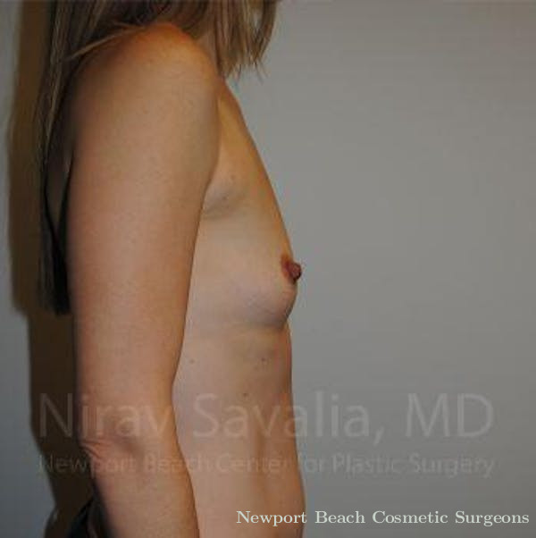 Abdominoplasty Tummy Tuck Before & After Gallery - Patient 1655580 - Before