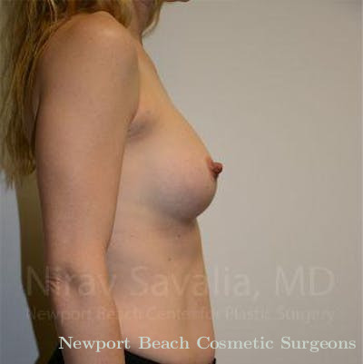 Mastectomy Reconstruction Revision Before & After Gallery - Patient 1655580 - After